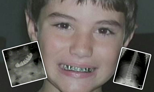Seven-Year-Old Florida Boy Swallows Grill!